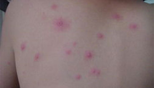 ��Ⱦˮ�������ܺ� ˮ����֢״������